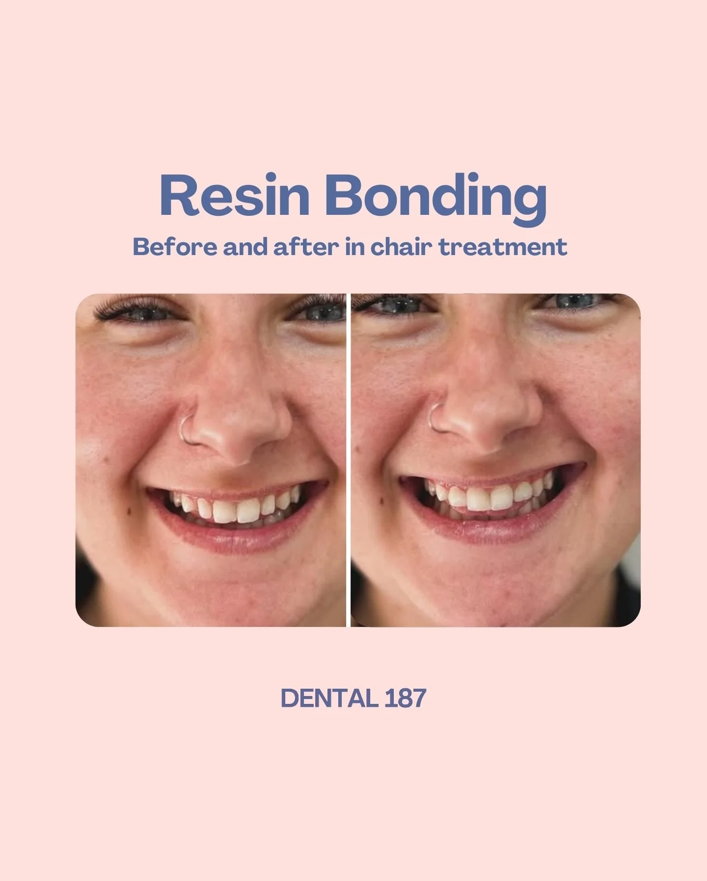 A naturally enhanced smile in just one visit!

Dr Liz used resin bonding on this patient to subtly reduce gaps and create a beautifully even smile. No pain, no needles, and no damage to the natural teeth.

Enhancing your smile doesn&rsquo;t have to b