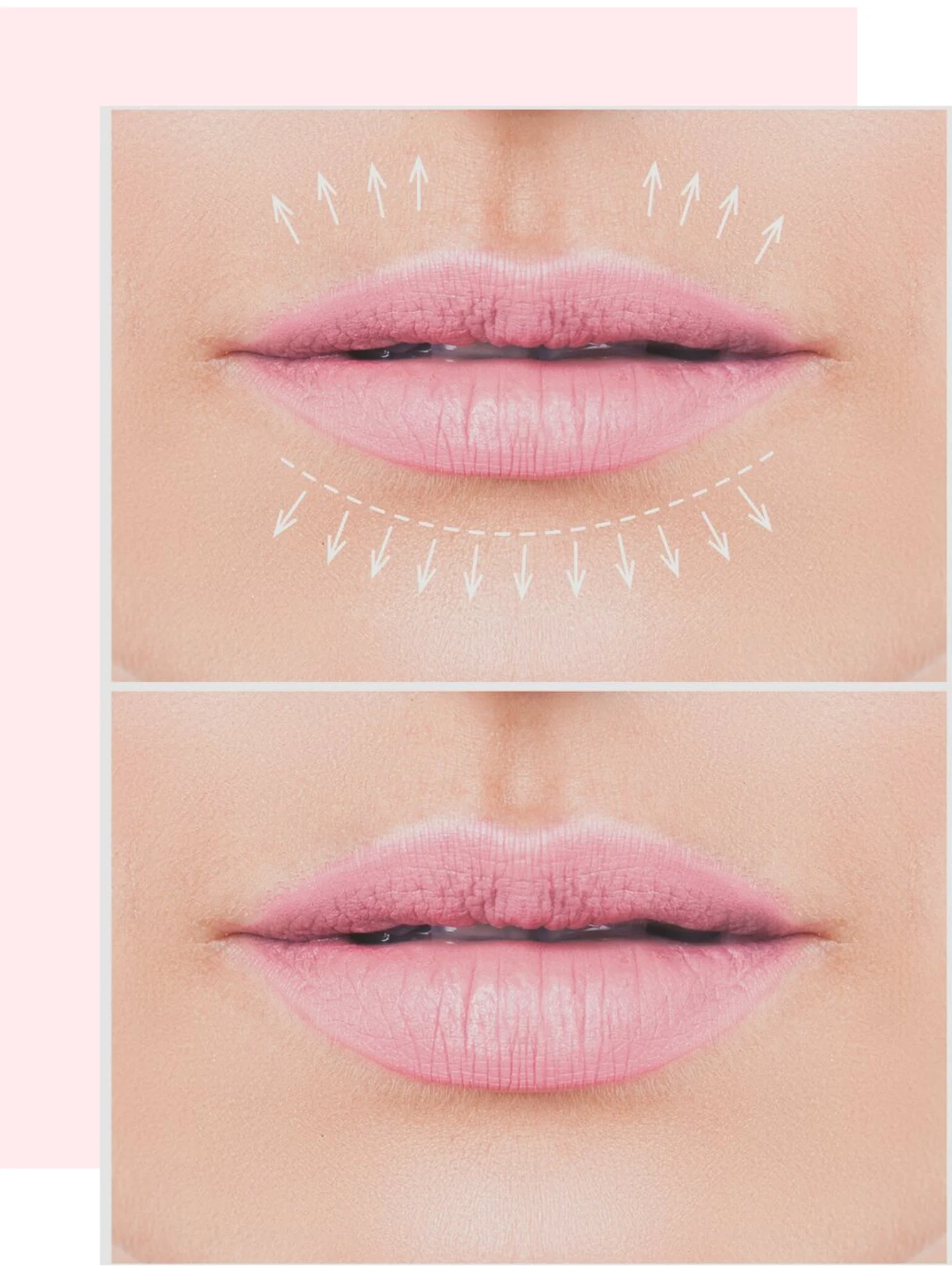 London-Aesthetics-Company-Lip-Fillers.jpg