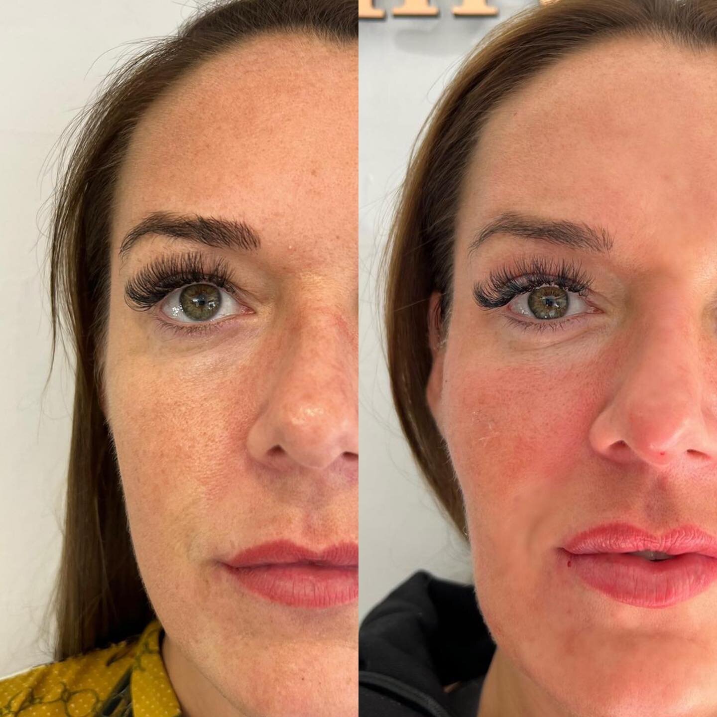 Profhilo Skin Transformation, our favourite 𝙄𝙣𝙟𝙚𝙘𝙩𝙖𝙗𝙡𝙚 𝙈𝙤𝙞𝙨𝙩𝙪𝙧𝙞𝙨𝙚𝙧 💧💭

✔️ Better skin texture 
✔️ Smoother skin 
✔️ Hydrated 

Wake up with 𝐠𝐥𝐨𝐰𝐢𝐧𝐠, 𝐩𝐥𝐮𝐦𝐩𝐞𝐝, 𝐬𝐦𝐨𝐨𝐭𝐡 filter-free skin everyday 💧

(Her skin is