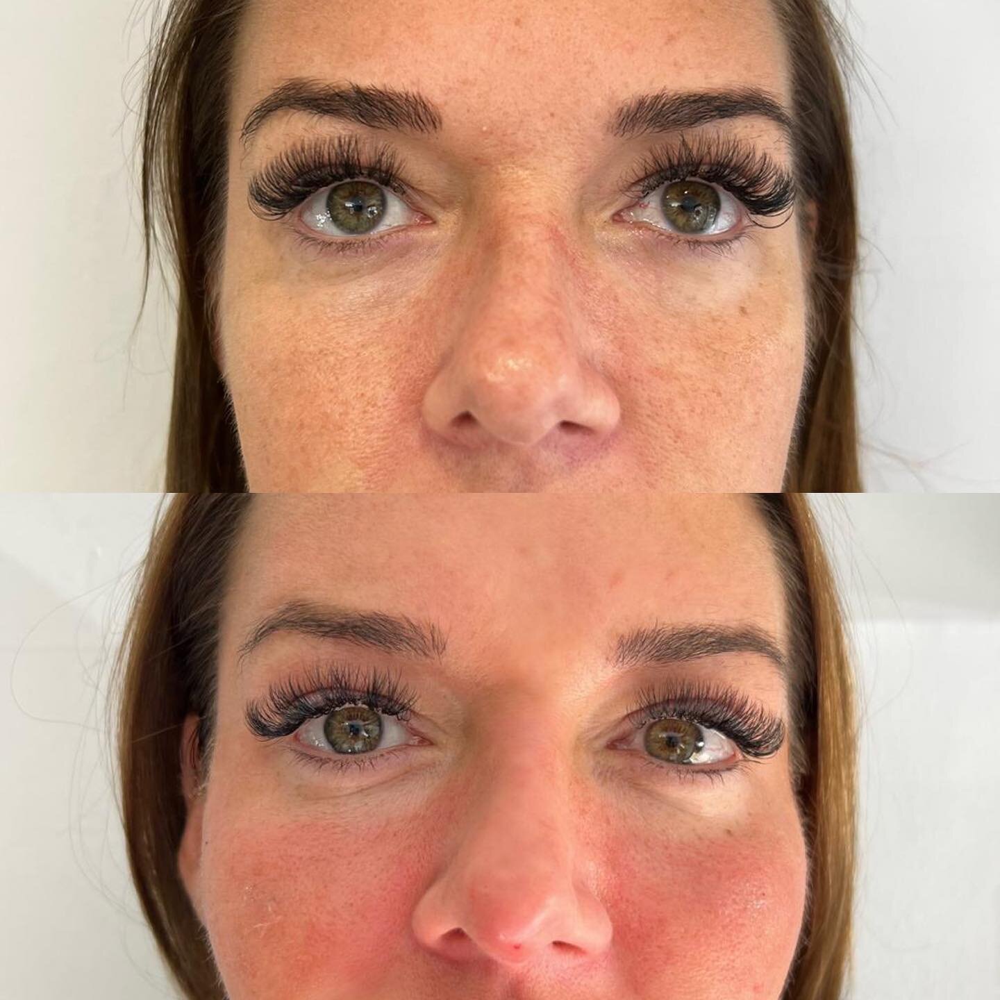 Who knew Cheek Filler could make such a difference? 😍💉

The cheeks are the beautification point of a female face, so enhancing them and adding a contoured defined look to the cheekbone makes the face more balanced and proportionate ✨

📲 BOOK your 