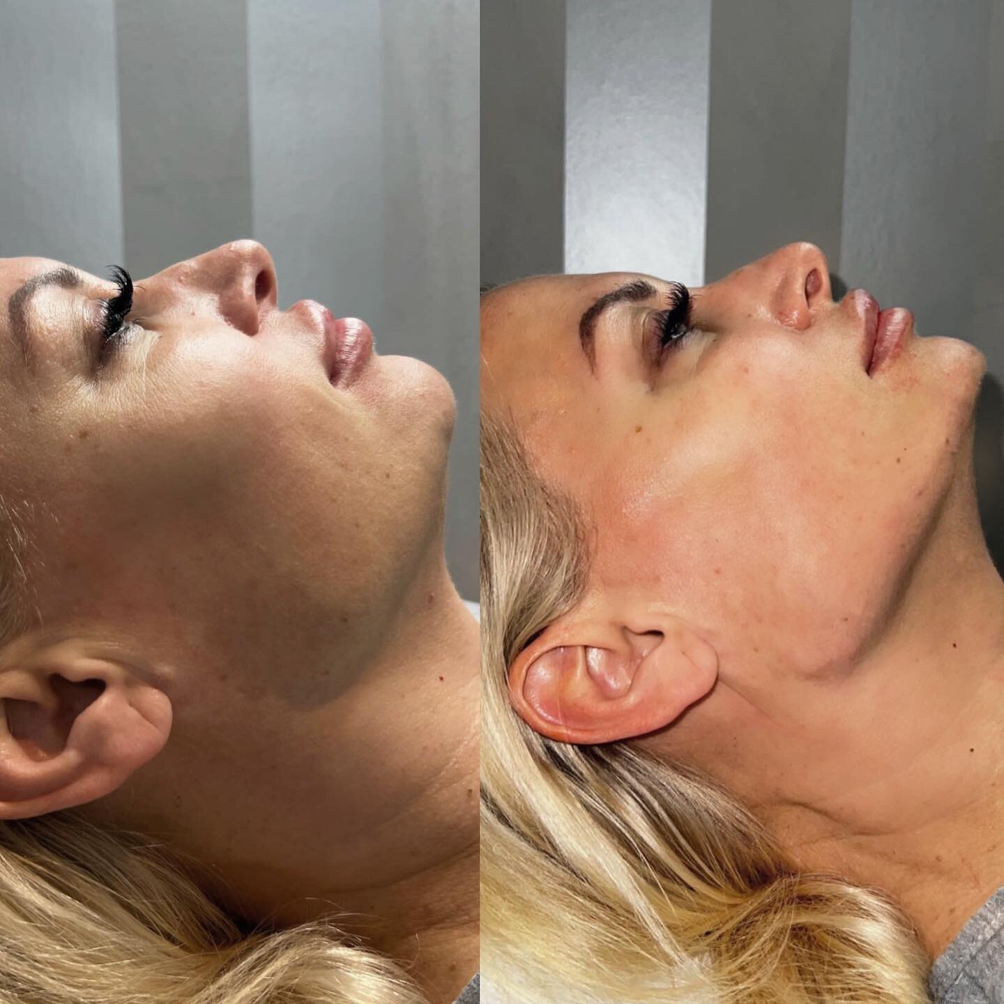 Imagine going into the weekend with a brand new sharp side profile like this 😍📐 

Another facial contouring result by Amrit 💉 

💻 Book Jawline or Cheek Contouring with dermal filler at our Essex or London clinic 

📲 BOOK at The London Aesthetics