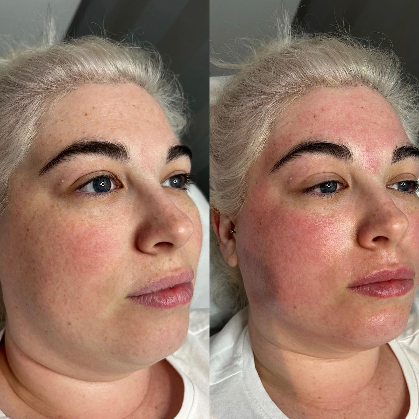 Immediate results from Fractional Skin Resurfacing ✨ 𝗕𝗘𝗡𝗘𝗙𝗜𝗧𝗦 ⬇️

&bull; Resurfaces skin texture 
&bull; Anti ages 
&bull; Tightens &amp; plumps skin 
&bull; Reduces acne scarring &amp; blemishes on the skin 
&bull; Lifts 
&bull; Reduces jowl