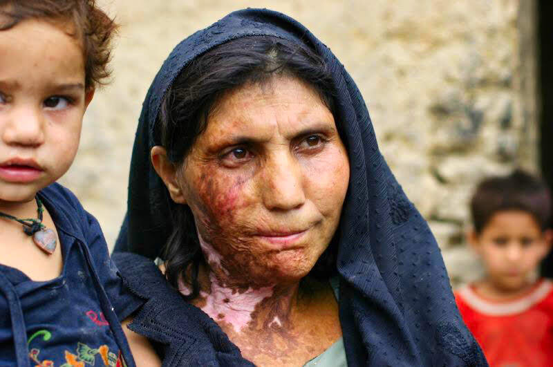 1.009.11Afghan.woman.burned.bomb.war.jpg