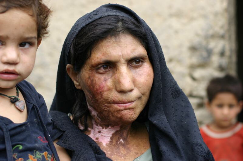018__1.009.11afghan.woman_.burned.bomb_.war_.jpg