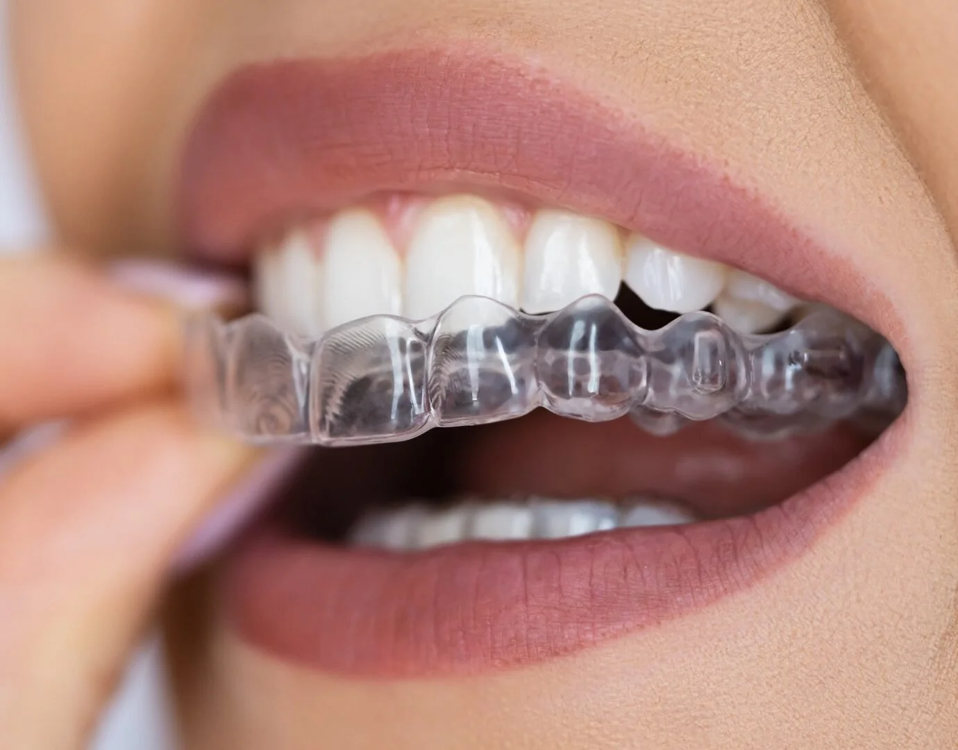 Aligners-2-1-1.jpg