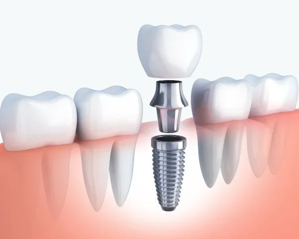 Dental+implants+in+London.webp