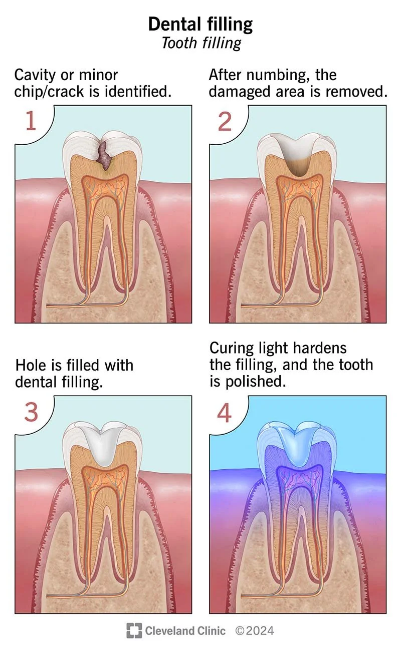 dental-filling.jpg
