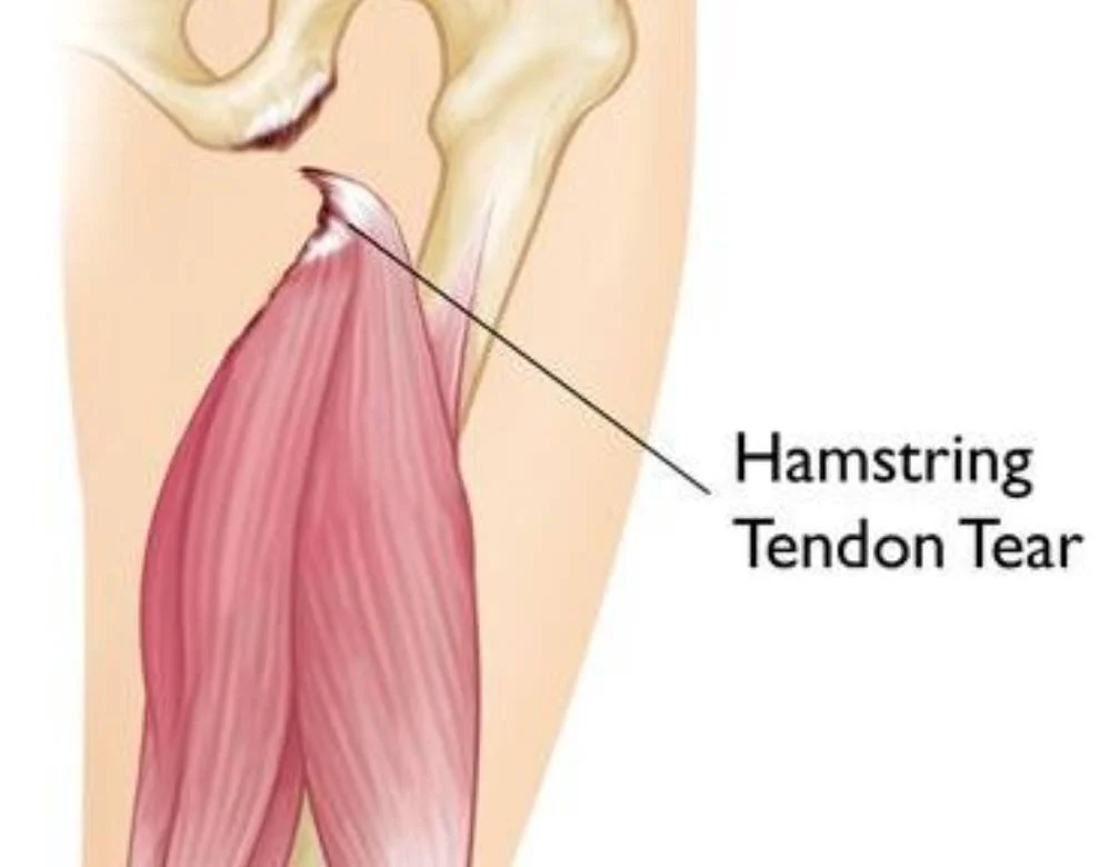 Hamstring Tendinopathy vs Hamstring Strain: Explained
