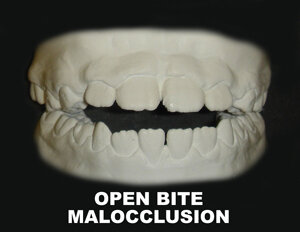 OPEN BITE MALOCCLUSION - Copy.jpg