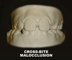 CROSS-BITE MALOCCLUSION.jpg