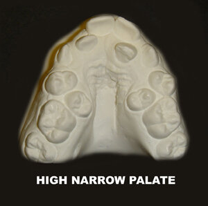 HIGH NARROW PALATE.jpg