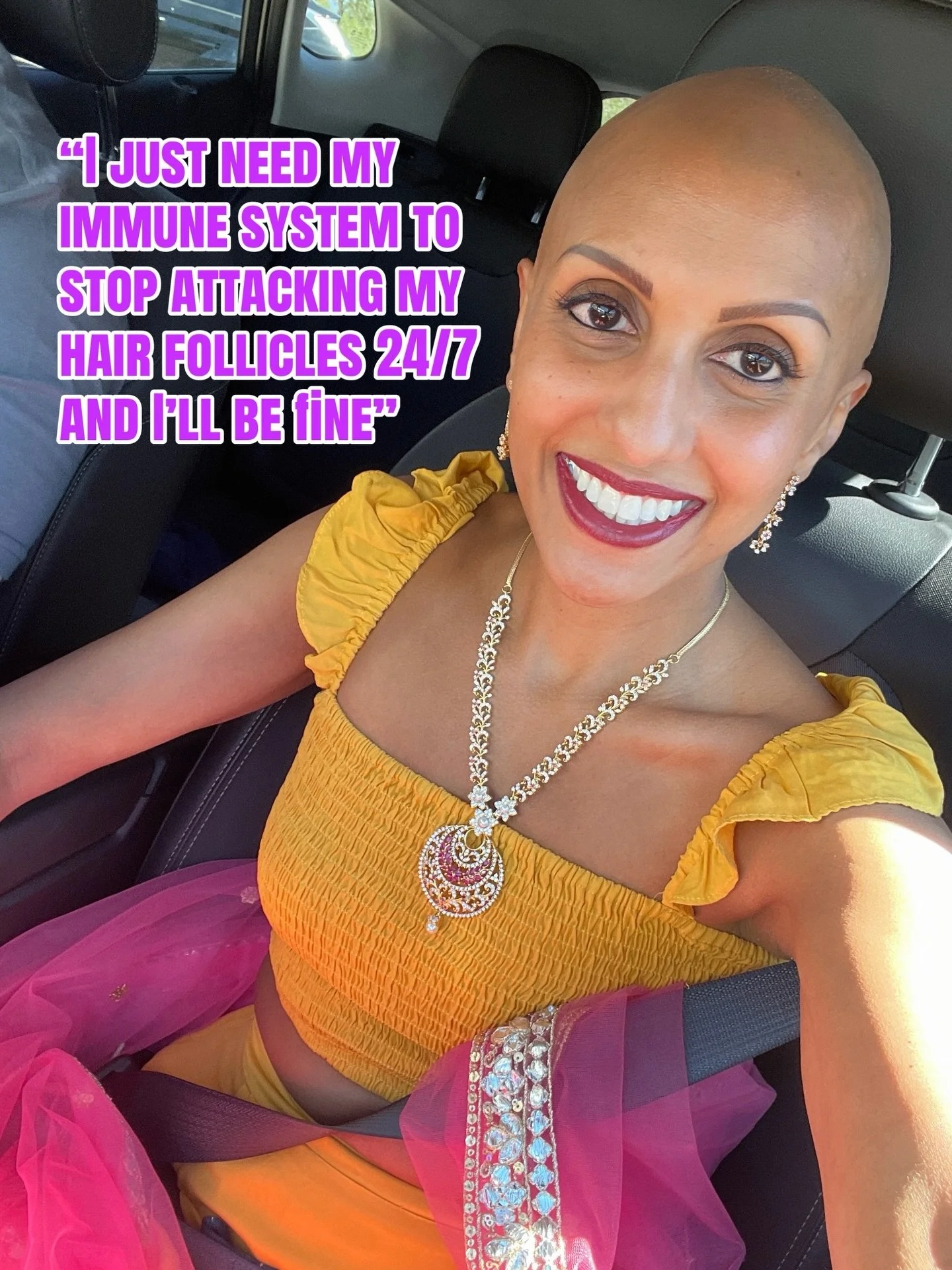 When your immune system giveth and your immune system taketh away 👩🏽&zwj;🦲🙃

#alopeciaareata #alopecia #alopeciauniversalis #alopeciatotalis #femalehairloss
