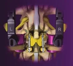 Medialized, Muscle-Splitting Approach for Posterior Lumbar Interbody Fusion