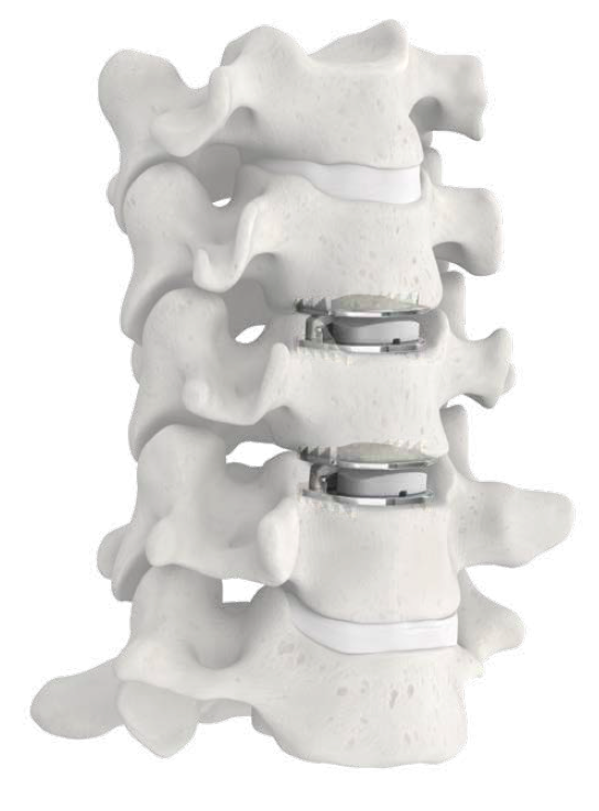 Discovering the Future of Spine Health: Artificial Cervical Disc Replacement (Mobi-C)