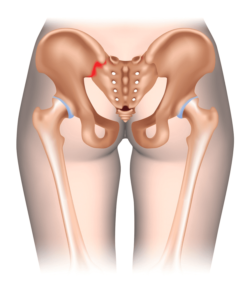 Is Your SI Joint Giving You Back Pain?