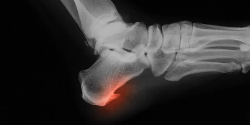 How Serious are Bone Spurs on the Spine?