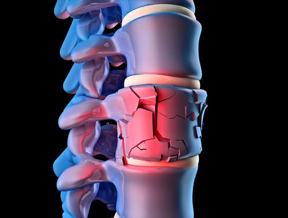 Spinal Trauma : Why Falls Have Overtaken Car Accidents as the Leading Cause