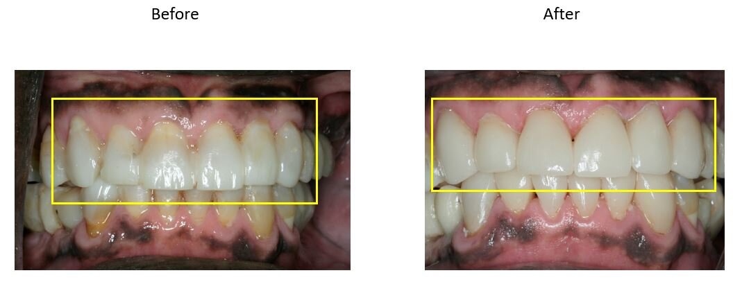  Above: New crowns (caps) were placed on the front six teeth of this patient to fix discoloration and broken down teeth. 