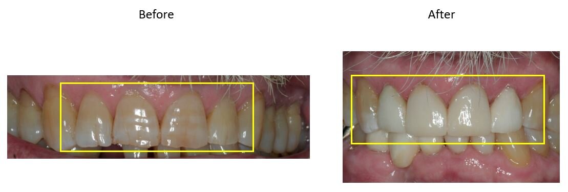  Above: Staining was present on the front four teeth from an antibiotic, tetracycline. Because this staining was due to a medication side effect, whitening is not effective so crowns were placed instead. 