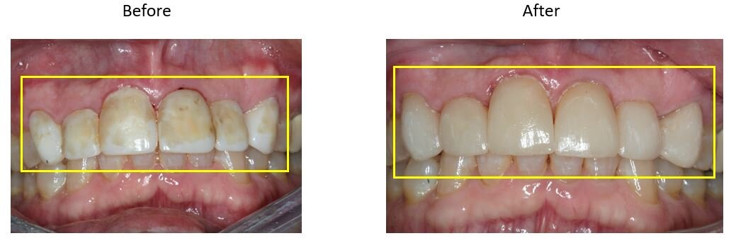  Above: This patient wanted something to improve the color and shape of their front six teeth, so new crowns were added to fix discoloration. 