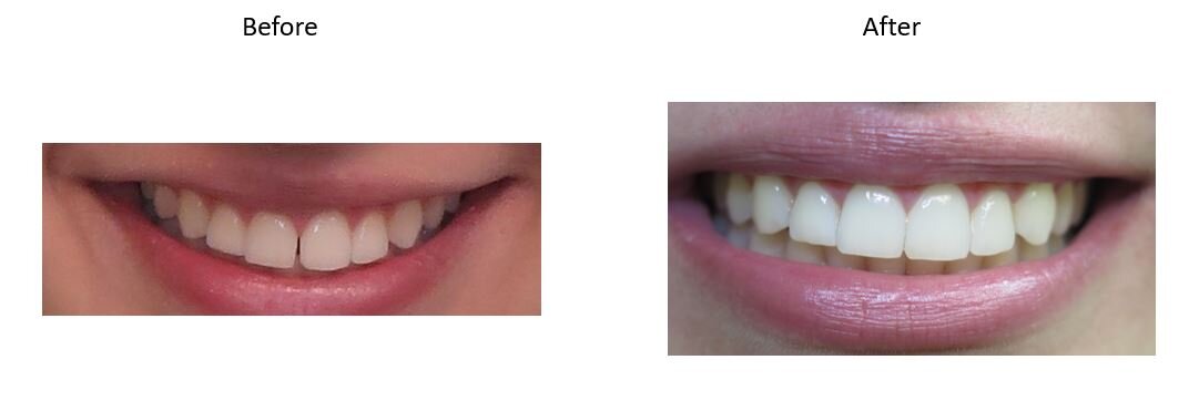  Above: Patient had braces in the past but her gap began opening up again. Invisalign was used to help correct it in ten weeks! 