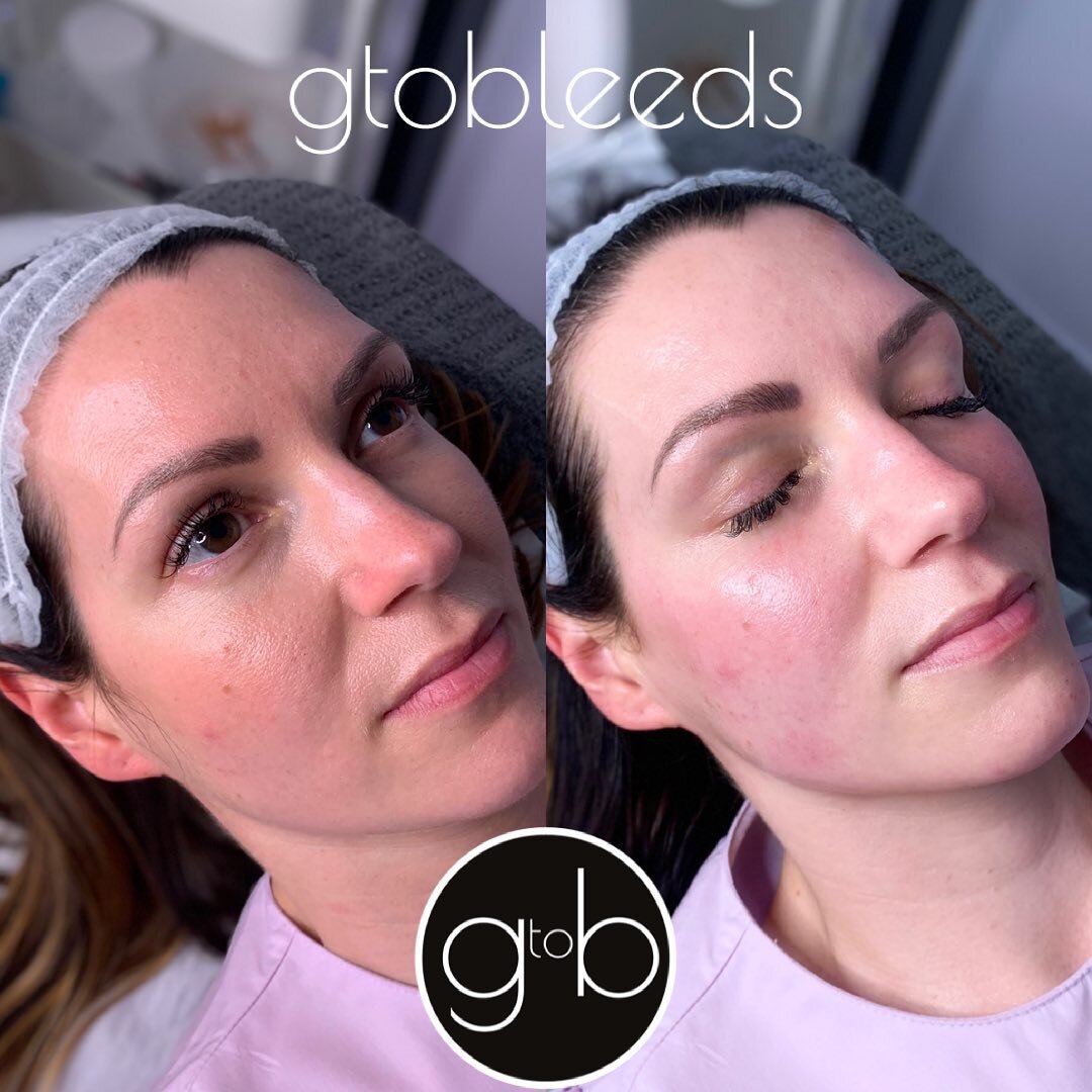 ⭐️ F L A W L E S S ⭐️ 
After a Dermaplane and Chemical Peel. No filters. No tricks. Just FLAWLESS skin 🤩
.
.
.
.
.
#skin #skincare #skincareroutine #skincareproducts #skincarecommunity #skincarejunkie #advancedskincare #advancedfacials #milliondolla