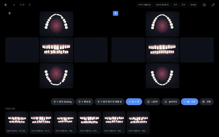 Full mouth view, five angles before and after