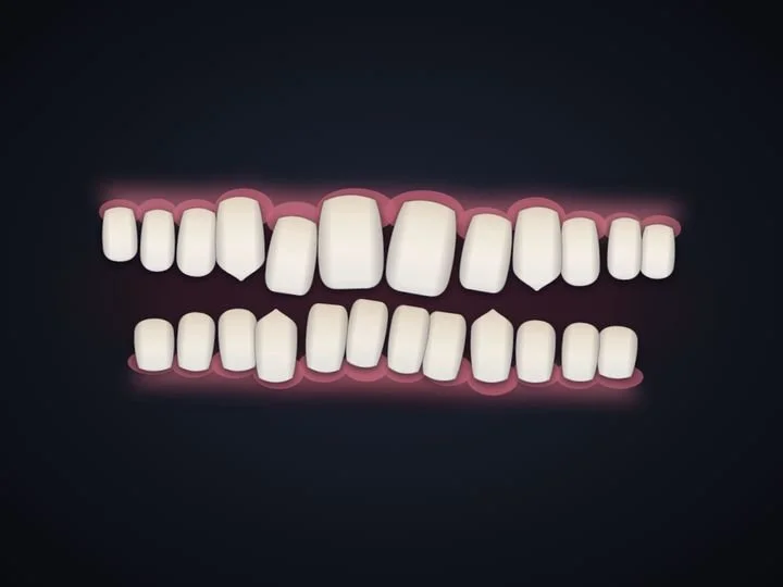 Slightly crooked teeth, drawn