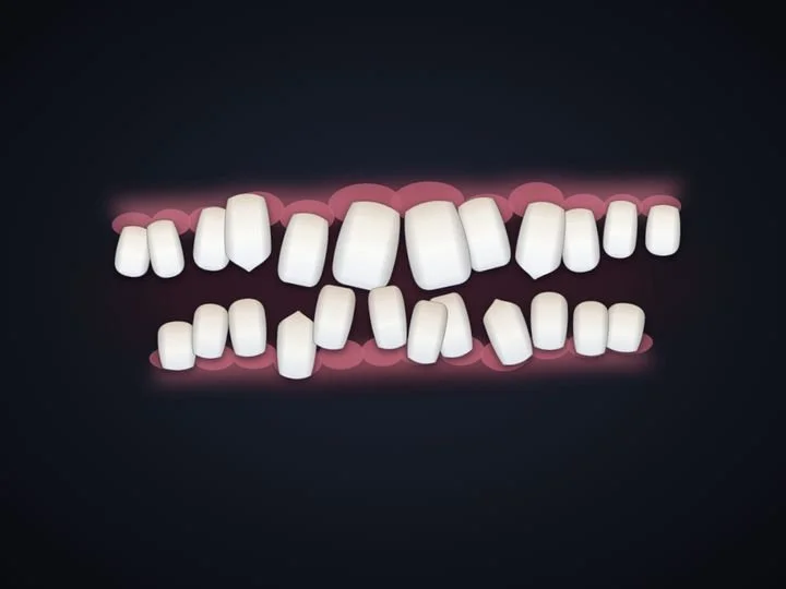 Crowded lower teeth, drawn