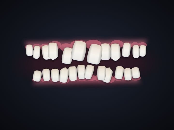 A narrow arch with crooked teeth, drawn