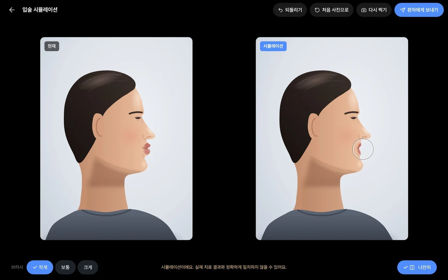The lip simulation screen: a drawn side profile, as taken on the left and with the lips pushed back by a brush on the right, the note that results may differ underneath