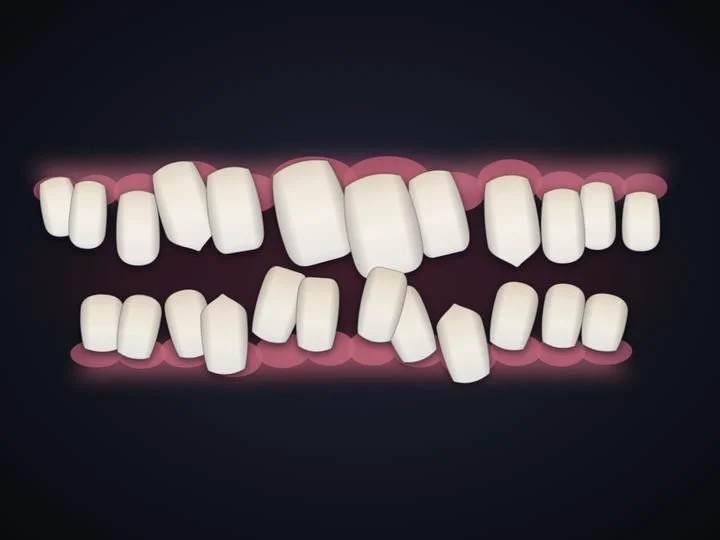 Crowded front teeth, drawn