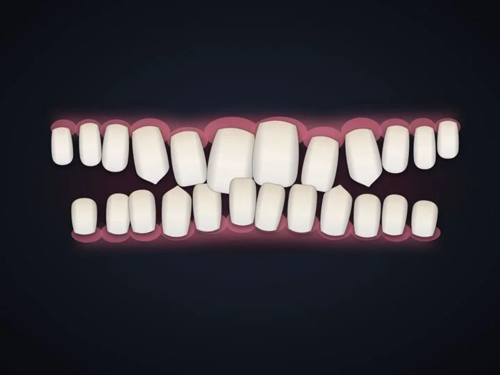 Upper teeth covering the lower ones, with gaps, drawn