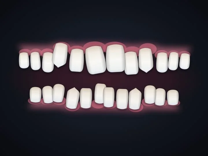 Front teeth that don’t meet, drawn