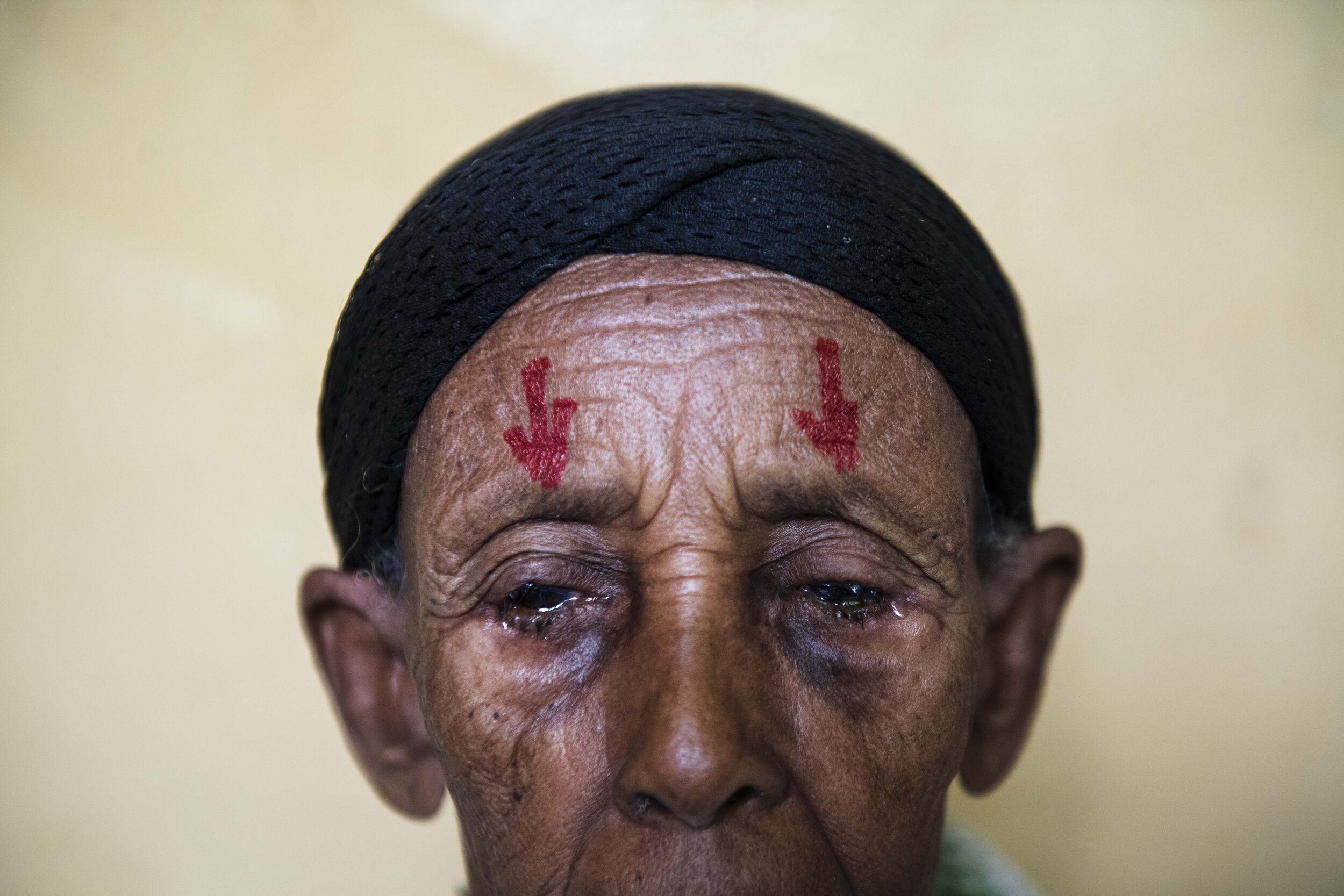  An elderly woman waits to be taken in for surgery.  She suffered from the blinding form of Trachoma in both eyes.  