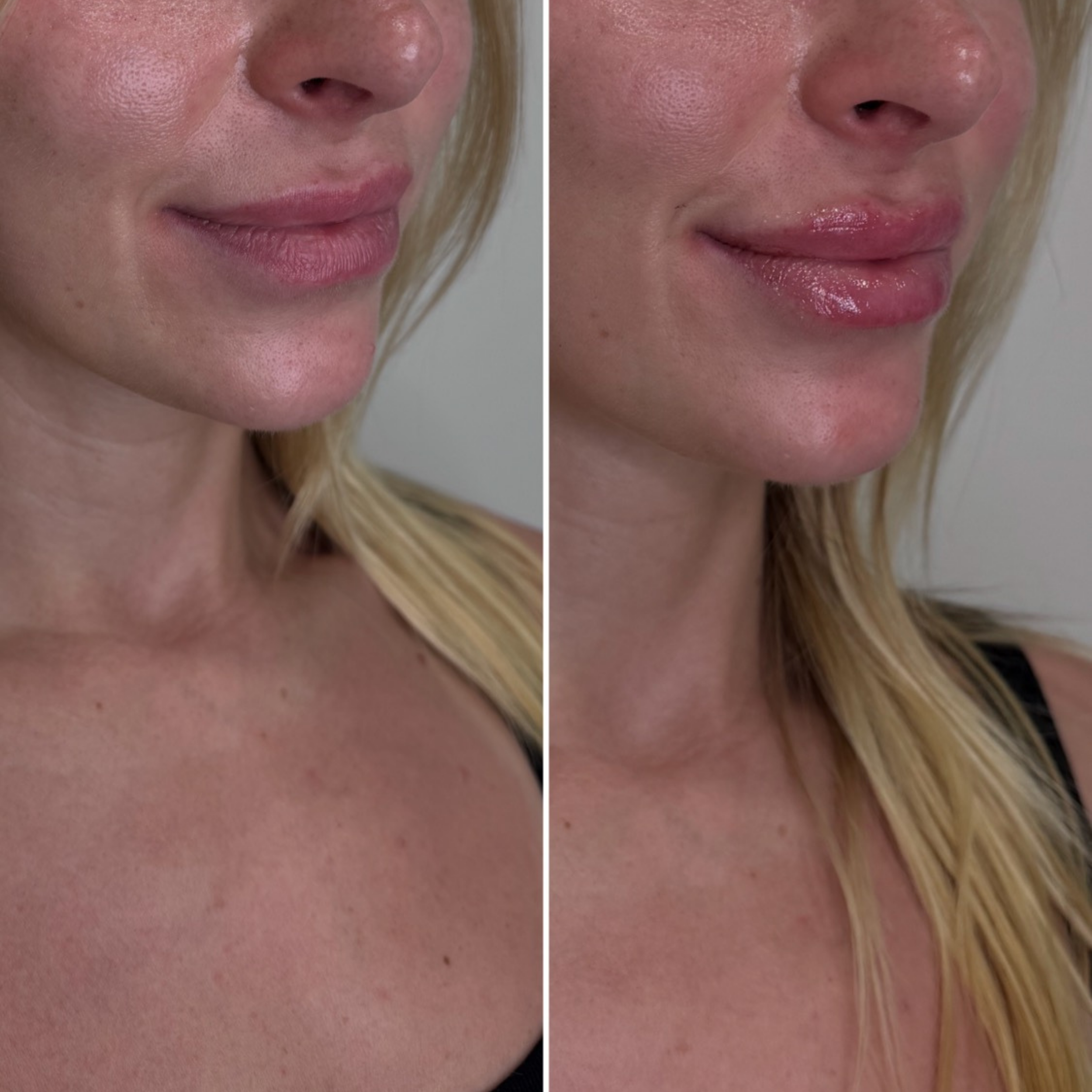 LIP FILLER