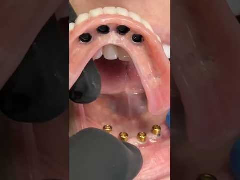 LSK121 - Correcting Implants with a Visiting Patient