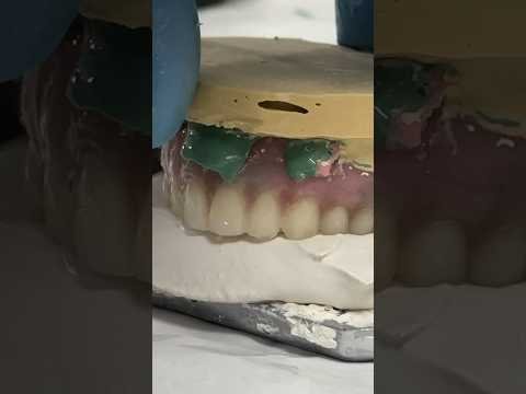 LSK121 - Denture Relining from Start to Finish