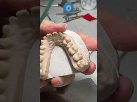How to finalize a 28-Unit Wax-Up