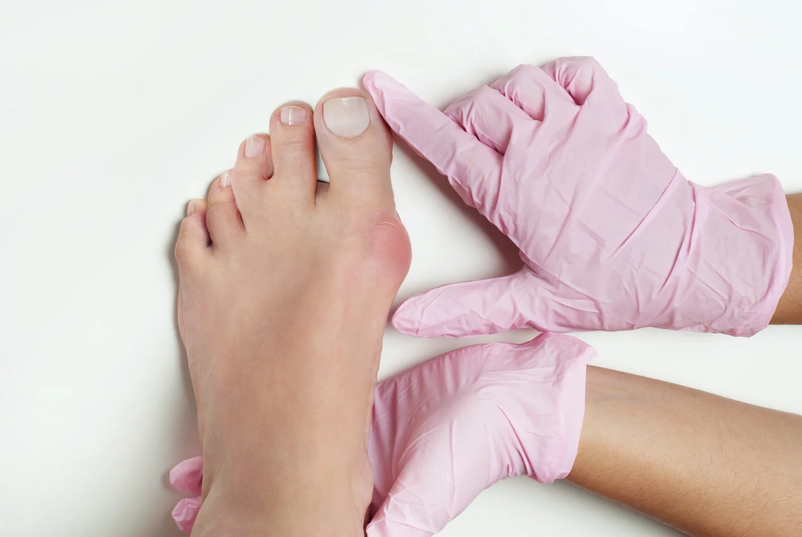 Bunion surgery recovery: A pair of hands in gloves hold a foot with a bunion