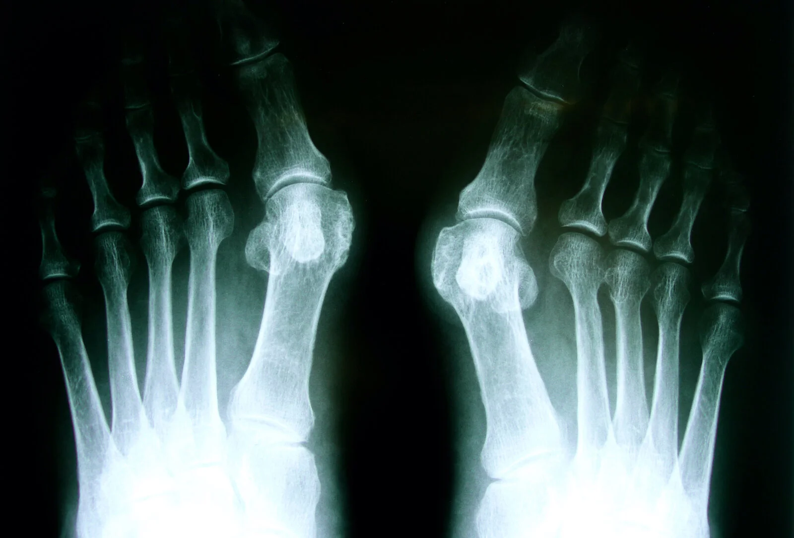 Bunion surgery recovery: An X-ray of feet