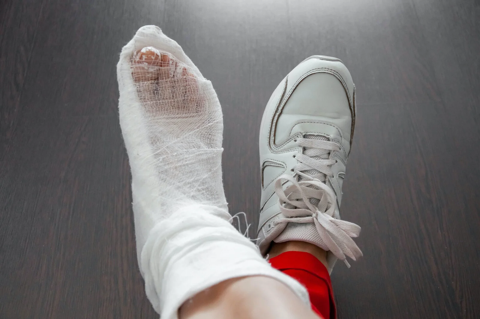 Bunion surgery recovery: A foot in a cast