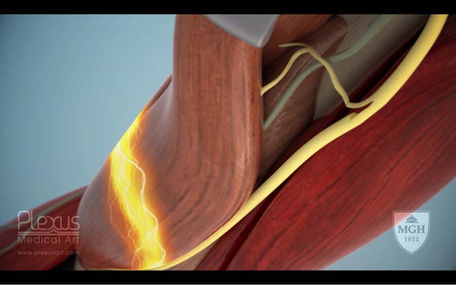 nerve-transfer-justin-brown