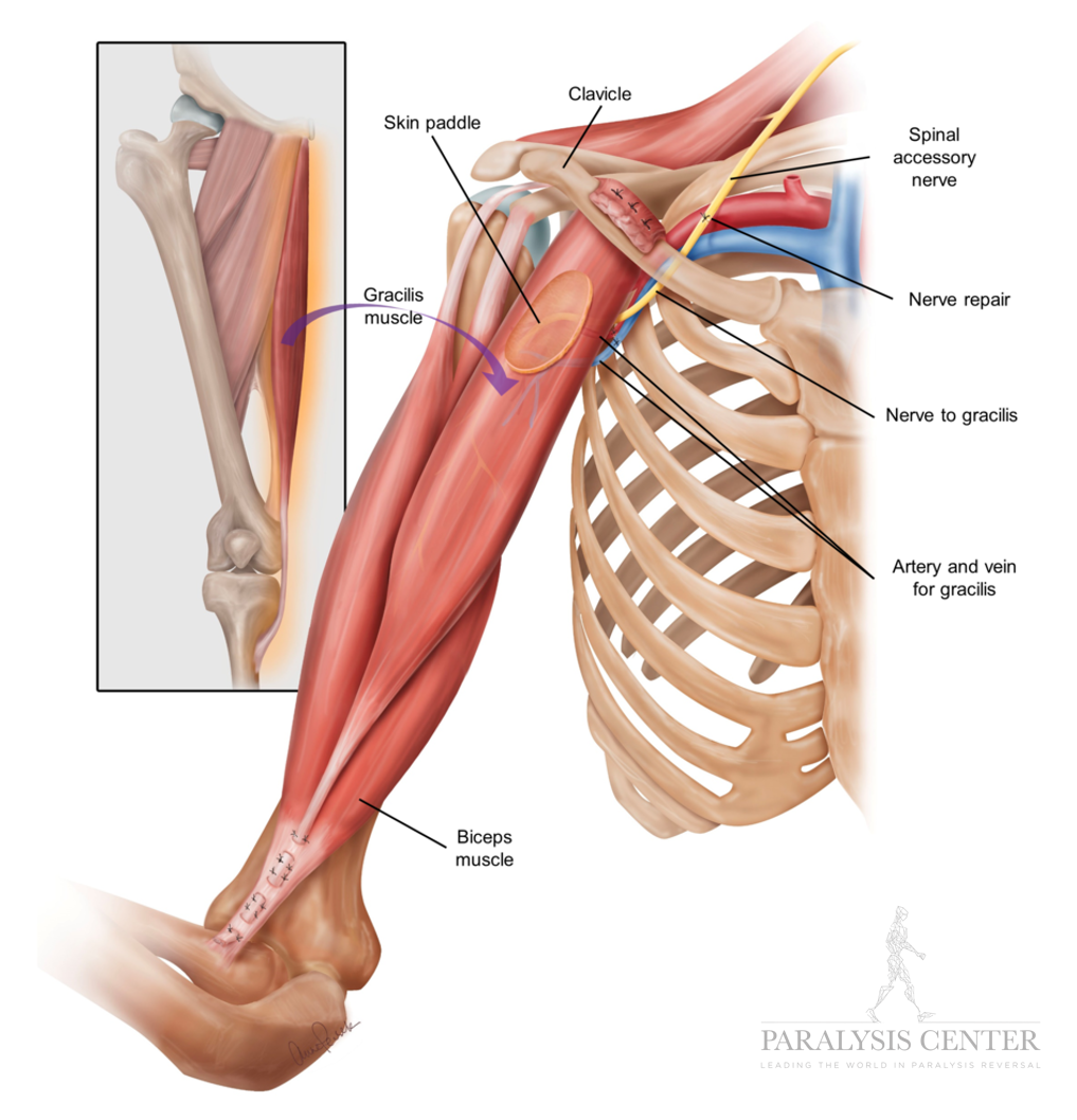 Muscle Transplant — Paralysis Center