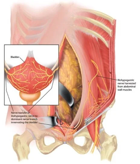 Nerve Transfer for Bladder Function