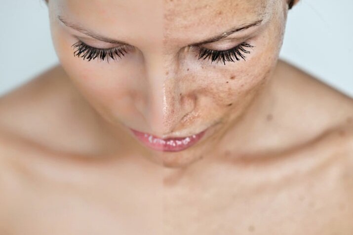 IPL+sun+spots+raleigh+botox+and+laser+center.jpg