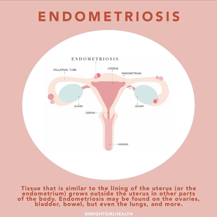 Endometriosis dietitian christie lee nutrition