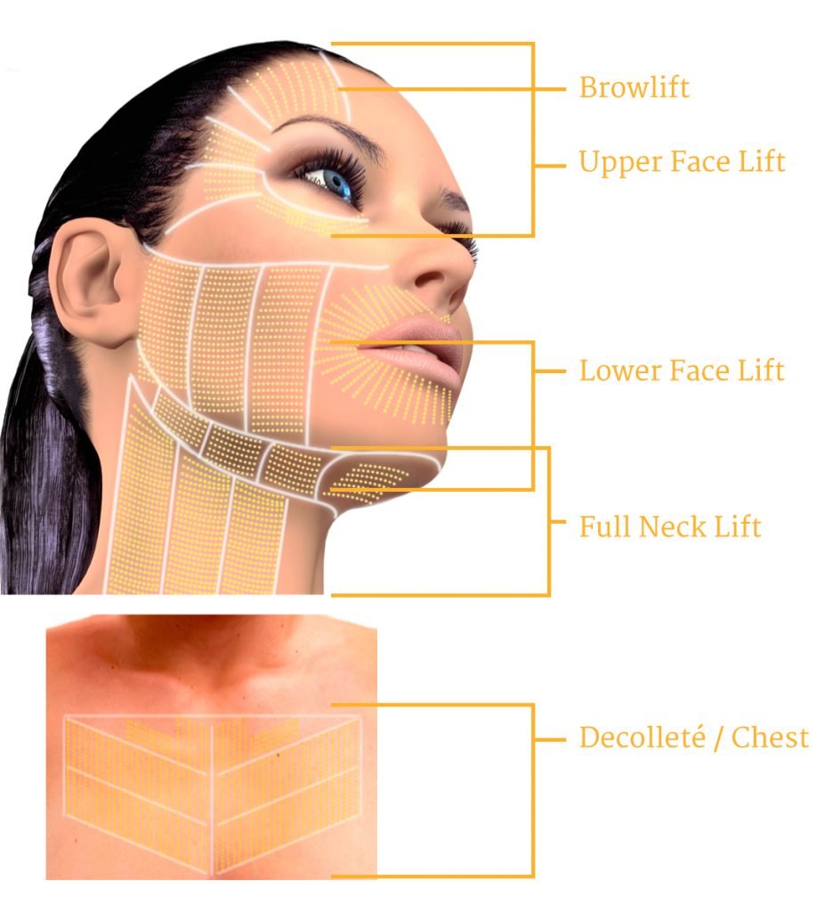 Ultherapy-Treatment-Areas-Map-917x1024.jpeg