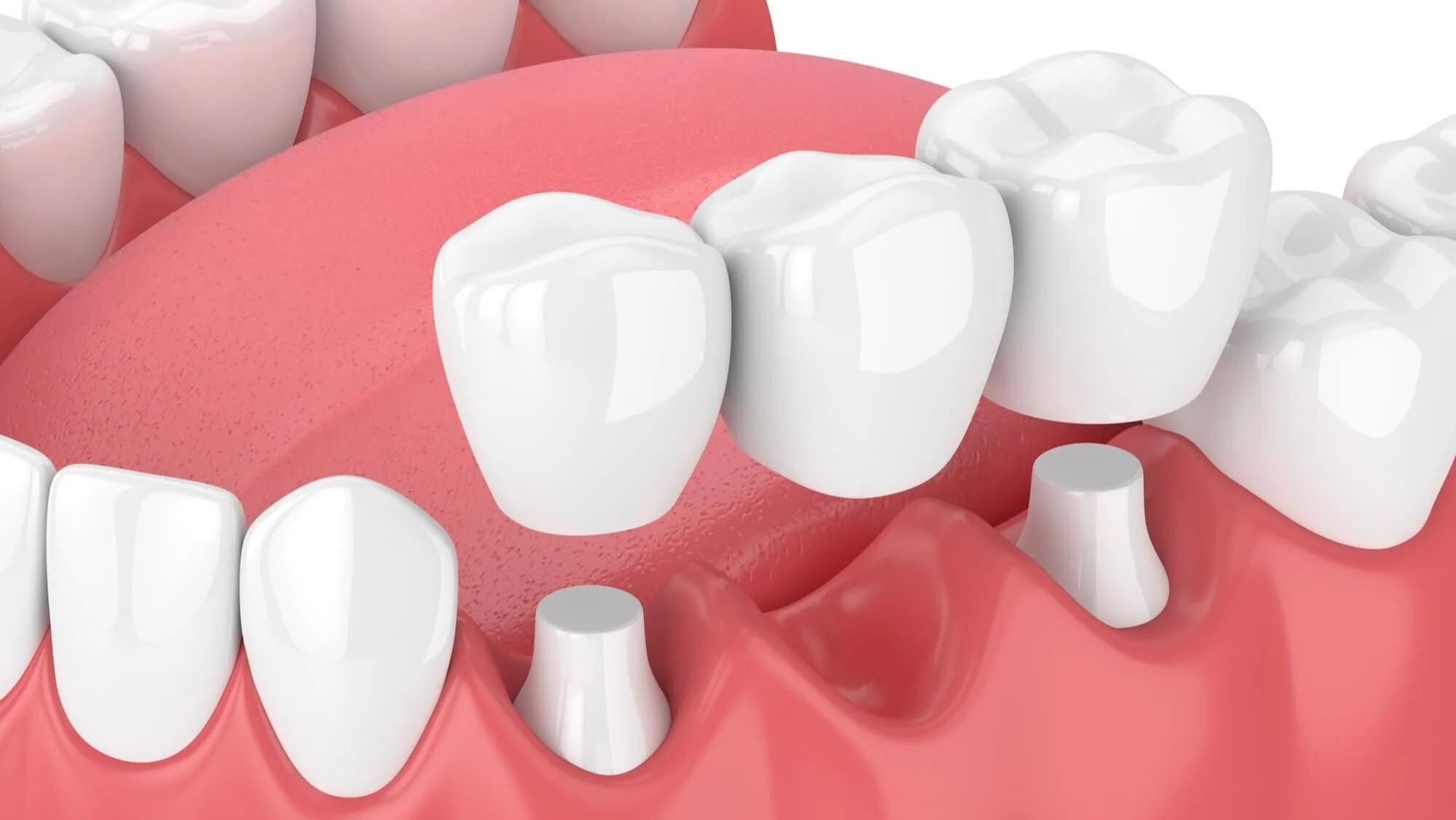 Bridge | Downtown University-Dundas Dentist, Dental Toronto