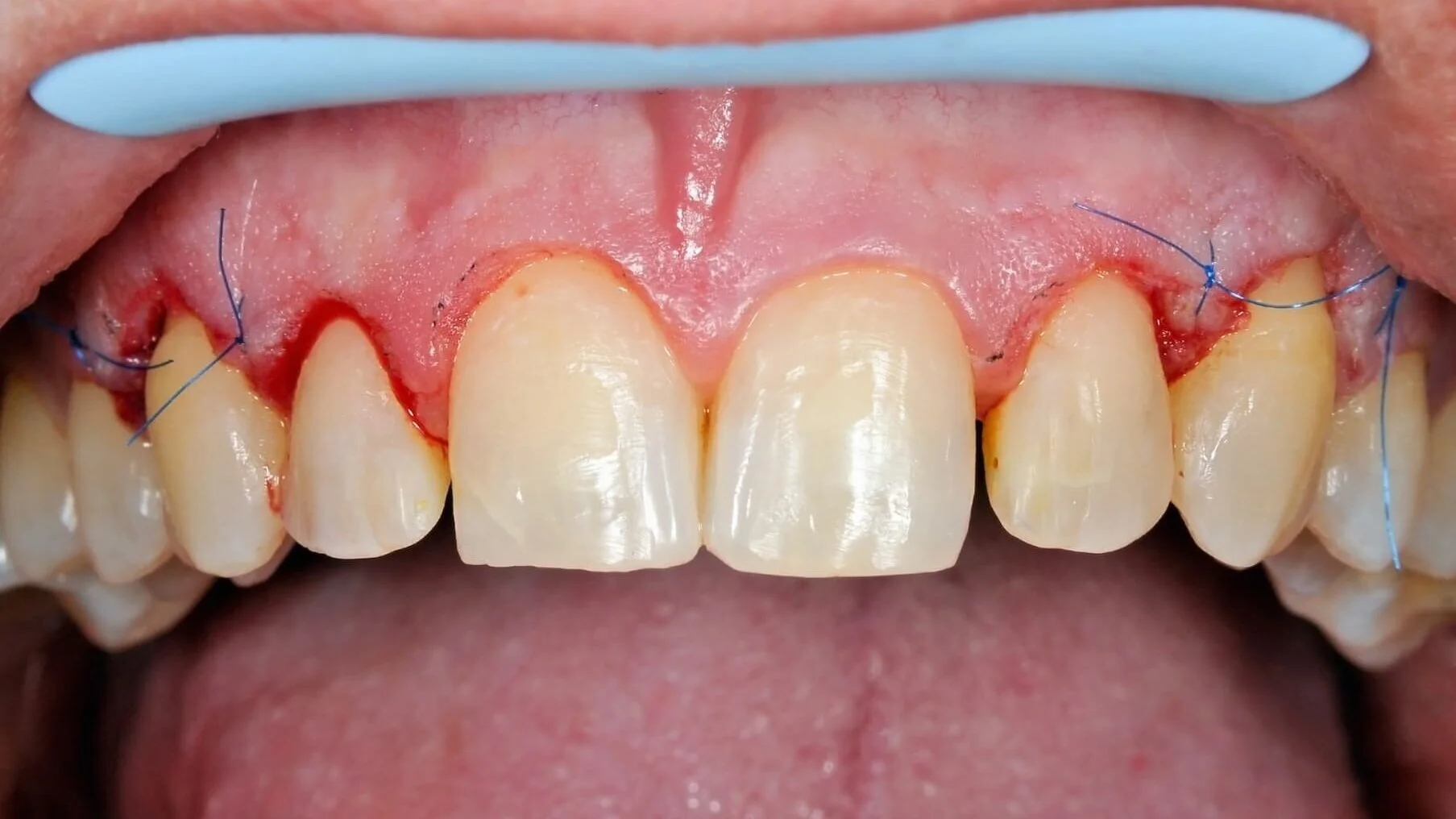 Dentist, Downtown Toronto Gum | University-Dundas Graft